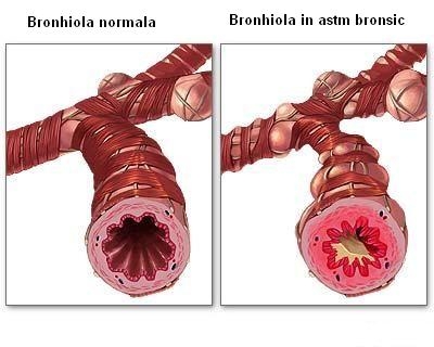 imagini tratamentul astmului